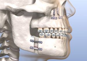 How Jaw Surgery Can Improve Function, Not Just Fix Problems