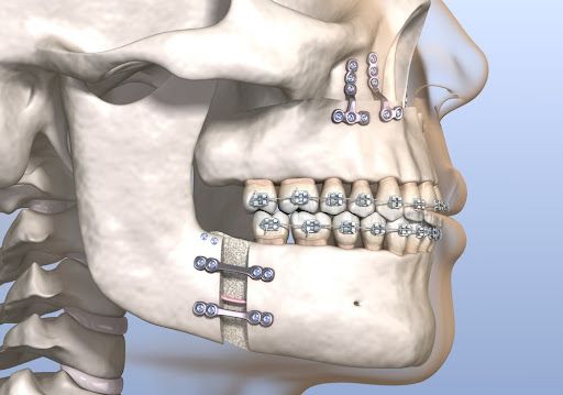 How Jaw Surgery Can Improve Function, Not Just Fix Problems